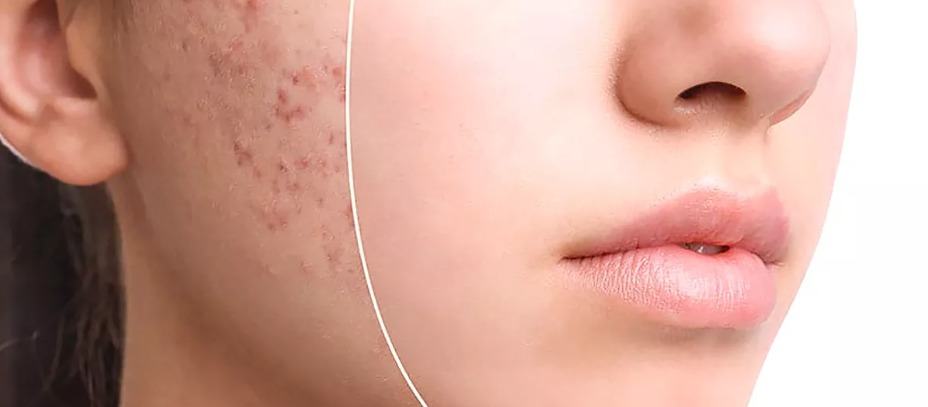 جوش و آکنه: بررسی علل، علائم و بهترین روش‌های درمان