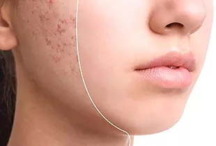 جوش و آکنه: بررسی علل، علائم و بهترین روش‌های درمان